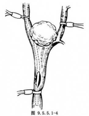 颈动脉瘤 颈动脉体瘤摘除术