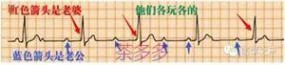 如何看心电图 简简单单，看懂心电图 （入门）