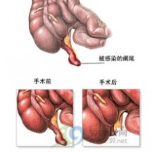 阑尾炎的症状 阑尾炎的常见症状是什么