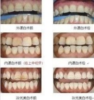漂白牙齿 牙齿漂白：牙齿漂白-概述，牙齿漂白-牙齿变色原因