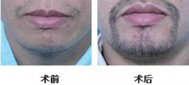 胡子 种胡须方法，怎么种胡须优缺点，注意事项，术后恢复