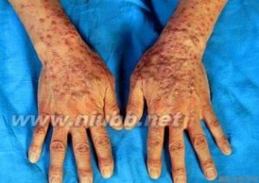 痒疹：痒疹-病因，痒疹-症状_夏季痒疹