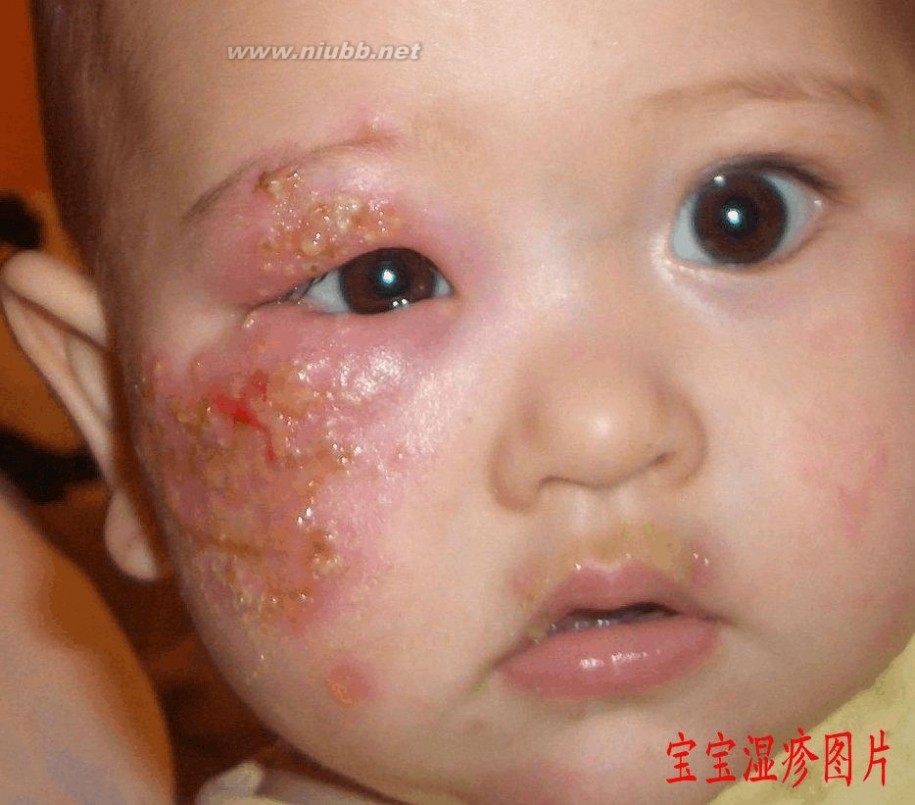 宝宝湿疹图片 宝宝湿疹照片