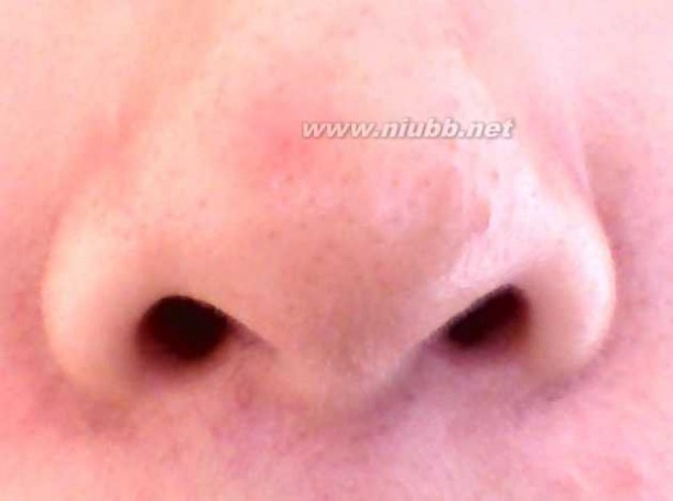 鼻子两侧有红血丝 鼻子两侧有红血丝 是怎么回事呢