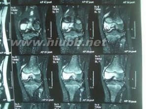 骨膜炎：骨膜炎-器官概述，骨膜炎-病因病理_跟骨骨膜炎