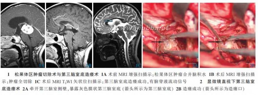 松果体 Poppen 入路显微手术切除松果体瘤