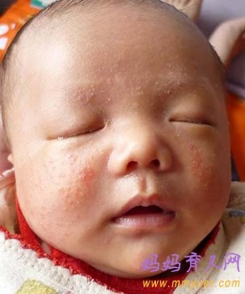 婴儿湿疹症状图片 什么是婴儿湿疹 婴儿湿疹症状图片