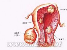 子宫平滑肌肉瘤 子宫平滑肌肉瘤的饮食禁忌 慎重选择放射治疗