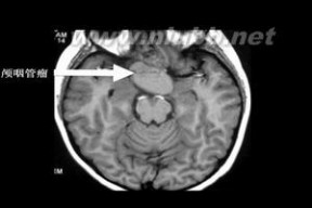 颅咽管瘤 颅咽管瘤：颅咽管瘤-概述，颅咽管瘤- 症状体征