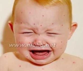 儿童皮肤过敏怎么办 皮肤过敏怎么办 剖析宝宝皮肤过敏的症状及治疗