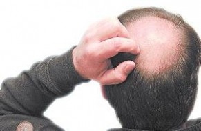 秃顶的原因 秃顶的原因有哪些？