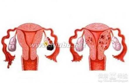 子宫内膜异位性不孕 子宫内膜异位症导致不孕该怎么办