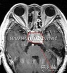 脑垂体瘤能治好吗 溴隐亭能治愈垂体瘤吗