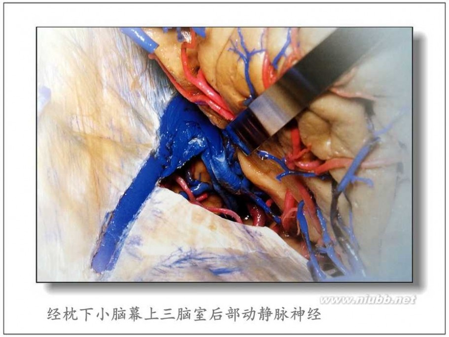 松果体 Poppen 入路显微手术切除松果体瘤