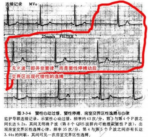 房室传导阻滞 房室传导阻滞治疗