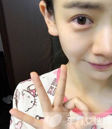 戚薇日本拍戏受伤 戚薇日本拍戏受伤 需做面部缝针手术