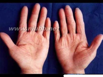鹅掌风病 四种与手癣区别的皮肤病(图)