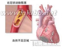 心脏搭桥手术：心脏搭桥手术-定义，心脏搭桥手术-手术风险_心脏搭桥手术