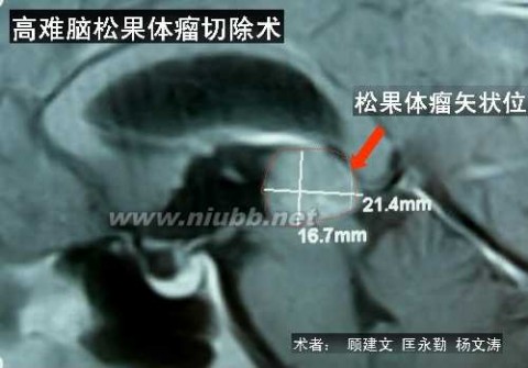 松果体 Poppen 入路显微手术切除松果体瘤