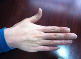 灰指甲偏方 如何治疗灰指甲偏方