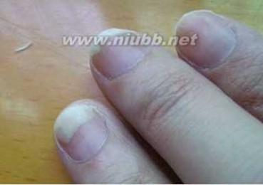 脚灰指甲的治疗偏方 脚灰指甲的治疗偏方 灰指甲该如何预防