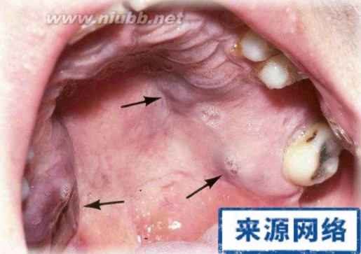 卡波氏肉瘤 艾滋病口腔卡波氏肉瘤症状与治疗