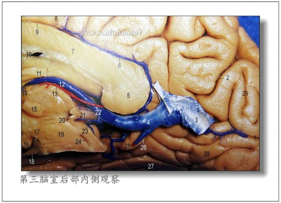 松果体 Poppen 入路显微手术切除松果体瘤