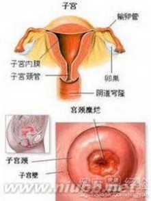 妇科中度炎症 中度宫颈炎如何治疗