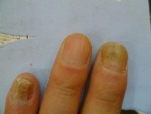 灰指甲偏方 如何治疗灰指甲偏方