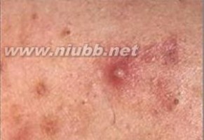 痤疮类型 痘痘分类常见的痤疮有哪些？