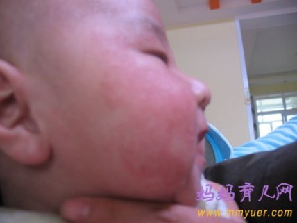 婴儿湿疹症状图片 什么是婴儿湿疹 婴儿湿疹症状图片