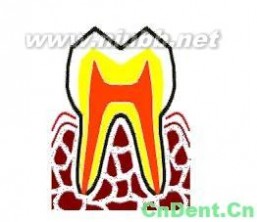 牙髓病：牙髓病-简介，牙髓病-病因_牙髓病