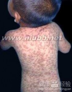 过敏治疗 出麻疹按皮肤过敏治疗对身体有无影响