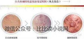 皮肤科痤疮 皮肤科医生：史上最全图文解说痘痘类型、症状及病因（收藏）