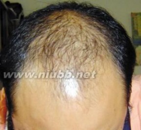 生发：生发-关于脱发，生发-六种生发食物_生发