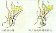 砂眼英文 沙眼