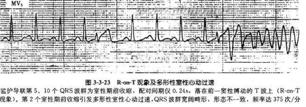 房室传导阻滞 房室传导阻滞治疗