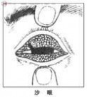 砂眼英文 沙眼