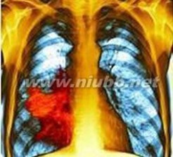 肺癌中期症状
