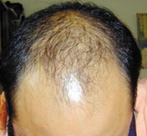 脂溢性脱发生发 生发的关于脱发