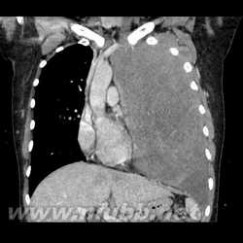 双侧肋膈角锐利 成功切除胸壁巨大肿瘤病例分享