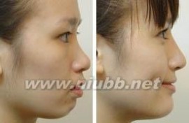 隆鼻：隆鼻-决定鼻子形态的因素，隆鼻-鼻子的美学标准_美容隆鼻