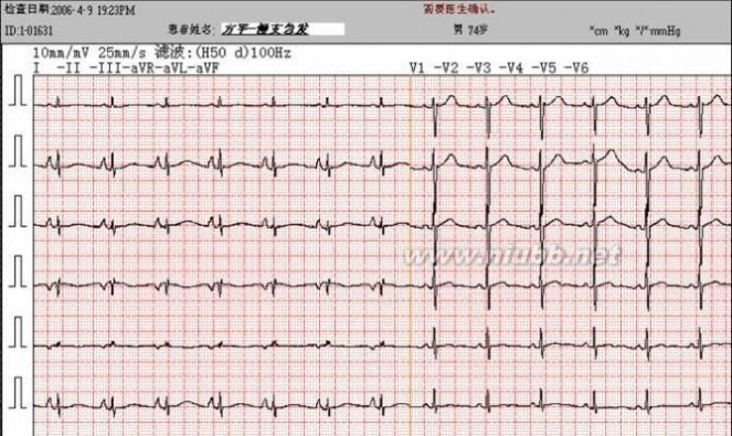 房室传导阻滞 房室传导阻滞治疗