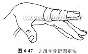 骨折：骨折-概述，骨折-骨折分类_开放性骨折