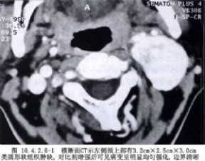 颈动脉瘤 颈动脉体瘤摘除术