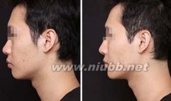 男性隆鼻 男人隆鼻效果前后对比图