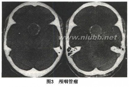 颅咽管瘤 小儿颅咽管瘤