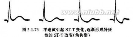 房室传导阻滞 房室传导阻滞治疗