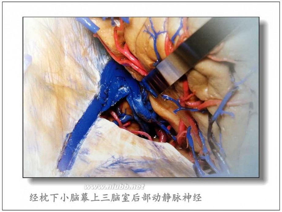 松果体 Poppen 入路显微手术切除松果体瘤