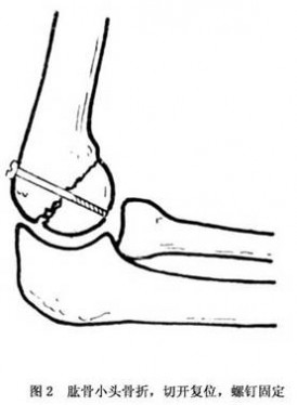 肱骨 肱骨小头骨折